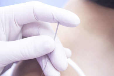 Biomedical Dry Needling